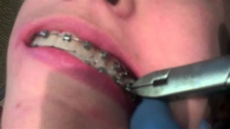 Hess Orthodontics Demonstrates How To Fix A Poking Wire On Braces In Valrico And Lithia Fl Youtube
