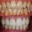 Improve Your Smile With These Teeth Whitening Tips  Fashion