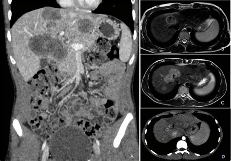 Metastatic Primary Adenocarcinoma Of Colon Case Report Of 15 Year Old Boy