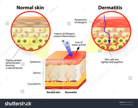 Skin Disease Dermatitis Eczema Labeled Diagram Vector Có Sẵn Miễn Phí