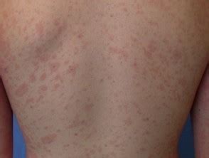 Pityriasis rosea is a type of skin rash. Pityriasis rosea images | DermNet NZ