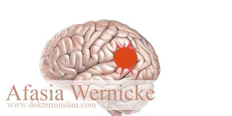 Muchas personas tienen afasia como resultado de un ataque cerebral. Afasia Wernicke : Kenali Gejala, Penyebab dan Pemeriksaan ...
