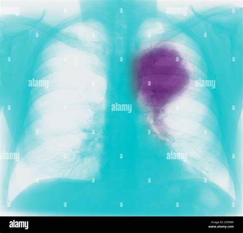 Colored Chest X Ray Showing Primary Lung Cancer The Malignant Tumour