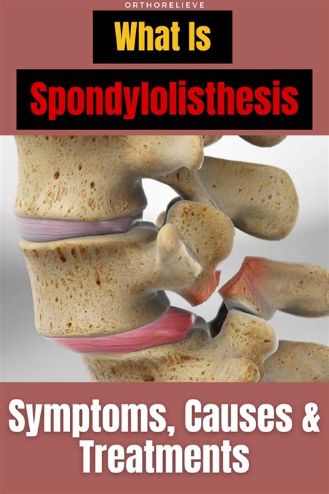 Spondylolisthesis Symptoms Causes And Treatments Artofit