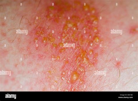 Non Bullous Impetigo Infection On The Surface Of Skin Caused By Either