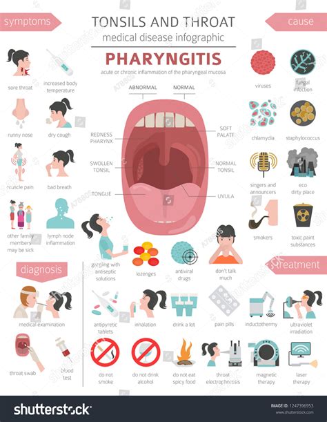 Tonsils Throat Diseases Pharyngitis Symptoms Treatment Stock Vector