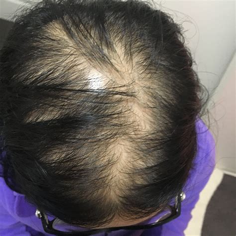 Female Pattern Baldness Pictures