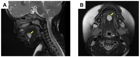 Sublingual Dermoid Cyst