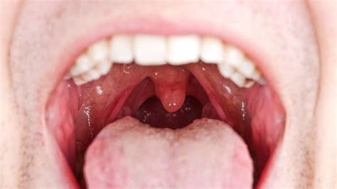 Mouth And Throat Cancer Medguidance