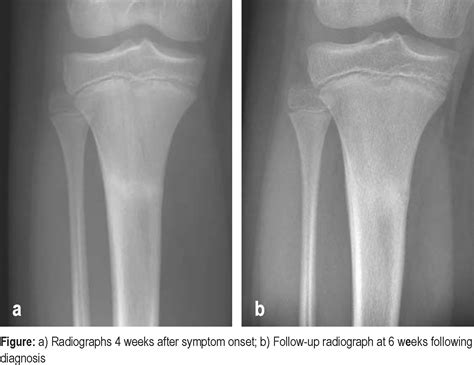 Stress Fracture Of The Proximal Tibia In An 11 Year Old Boy 16042021