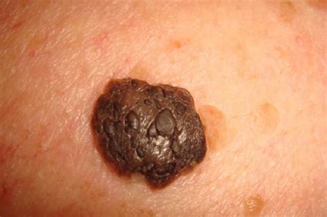 Seborrheic Keratoses The Most Common Benign Skin Tumor Of Humans