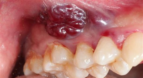 Small Red Spots On Roof Of Mouth Sore Throat Jameslemingthon Blog