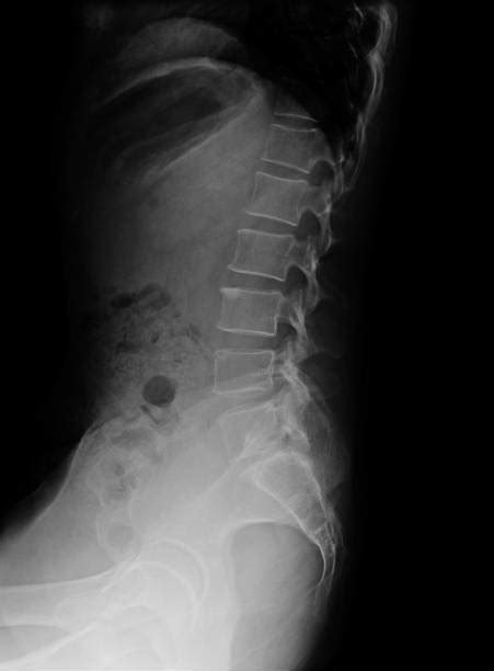 Imagen De Radiografía De La Pelvis Y La Columna Vertebral Vista Lateral