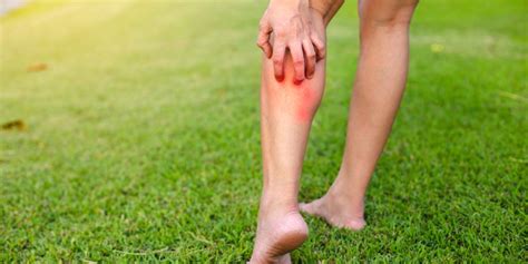 Home Remedies For Itchy Legs During Summer