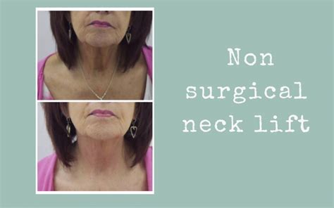 Non Surgical Neck Lift Ever Clinic Facial Aesthetics