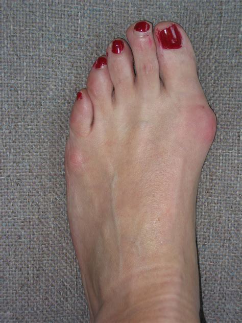 Bunion Foot Problems And Footwear Answers