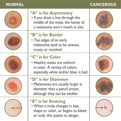 Skin Cancers Mohs Derm Houston