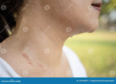 Female Neck With Sweat On Skinasian Woman With Atopic Allergy Skin