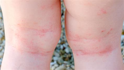 Dermatitis At Pica Nerea Pediatra