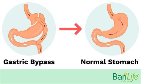 Gastric Bypass Reversal What Happens After It S Reversed