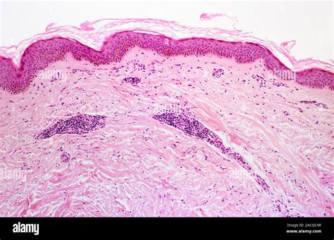 Psoriasis Light Micrograph Of A Section Through Skin Affected By