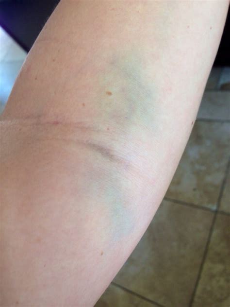 Drinking plenty of water and eating a small. Still have this bruise on my arm after getting blood drawn ...
