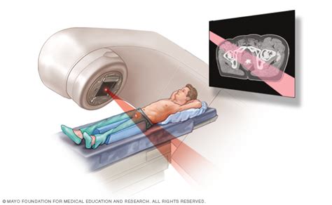 External Beam Radiation For Prostate Cancer Beacon Health System