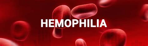 Bij een bloeding wordt daardoor een bloedklonter gevormd die minder stabiel is. Hemophilia - Causes, Signs, Symptoms, Types, Inheritance ...