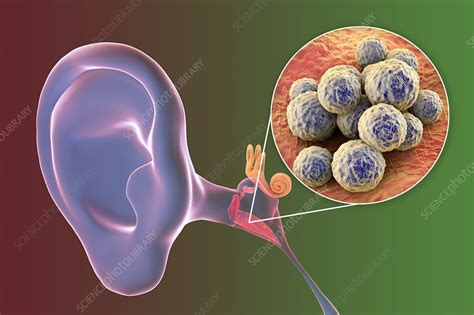 Otitis Media Ear Infection Illustration Stock Image F0325980