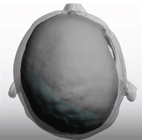 Custom Skull Implants In The Correction Of Occipital Plagiocephaly In