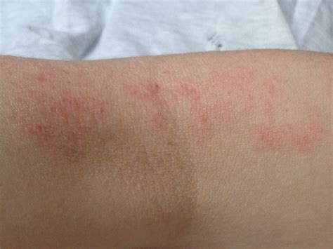 Dermatitis Atópica Síntomas Causas Y Tratamientos De Dermatitis