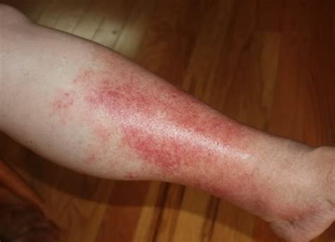 Cellulitis Skin Infection Universal Health Care
