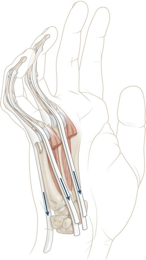 Claw Hand For Distal Ulnar Nerve Injury Or Chronic Compression Loss Of