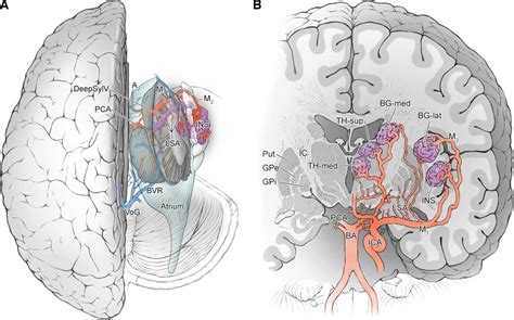 Deep Arteriovenous Malformations In The Basal Ganglia Thalamus And