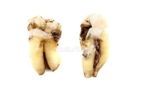 Decayed Wisdom Tooth Stock Photo Image Of Oral Human 140222546