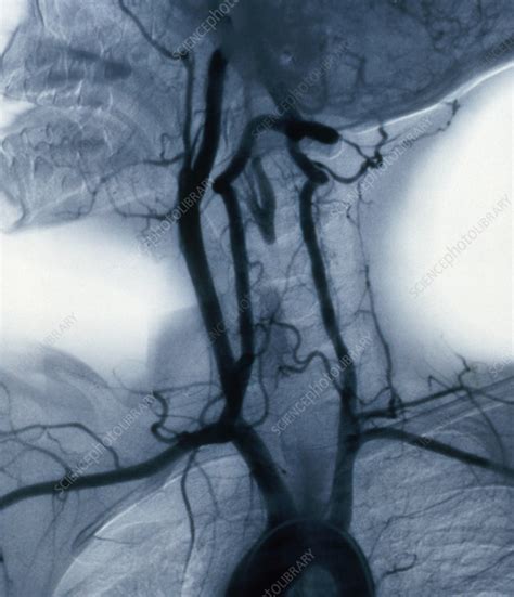 Angiogram Of Carotid Arteries Stock Image C0047408 Science Photo