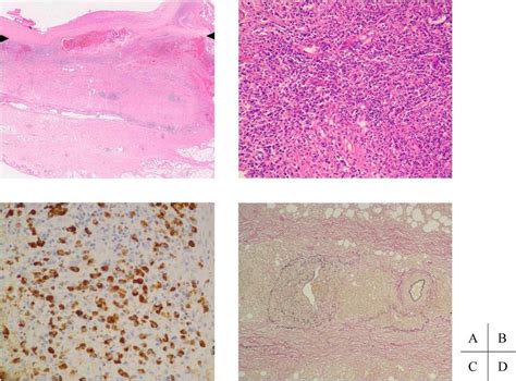 Histological Findings Of Igg4 Related Inflammatory Abdominal Aortic