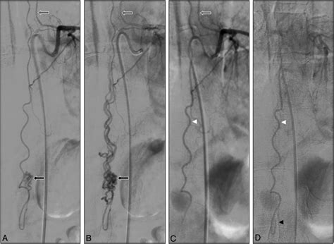 A And B Spinal Angiograms Showing The Great Anterior Radiculomedullary