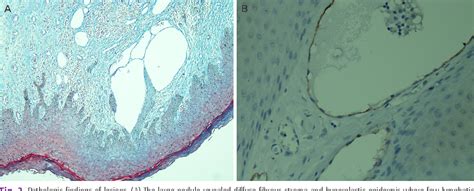 Figure 2 From Fibroepithelial Polyp Of The Vulva Accompanied By