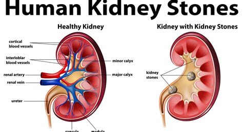 Make your own images with our meme generator or animated gif maker. Types of Kidney Stones | Amazed by Truth