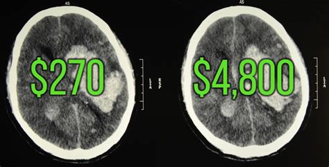 Why are ct scans so expensive? The cost of a CT scan | Two Views