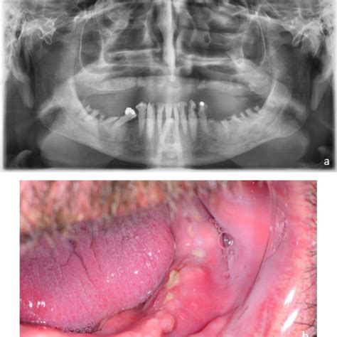 Pdf Osteonecrosis Of The Jaw In Patients With Inflammatory Bowel