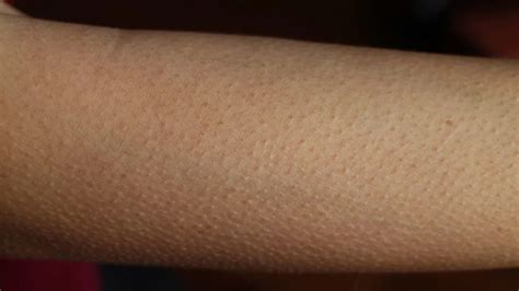 Goosebumps On The Skin Causes And Symptoms