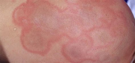 All About Rashes From Lyme Disease And Lyme Disease Treatment Tipstoday
