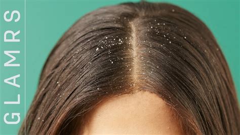 How To Get Rid Of Dandruff The Ultimate Hair Care Routine For