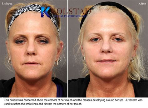 Juvederm San Diego To Treat Smile Lines Before And After Gallery 21 Dr