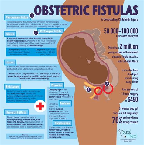 An Info Poster Showing The Benefits Of Obstetric Fisulas