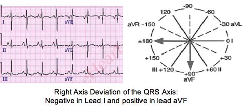 It can be normal, leftward (left axis deviation, or lad), rightward (right axis deviation, or rad) or indeterminate (northwest axis). Determine Axis on a 12-lead ECG Tracing | LearntheHeart.com