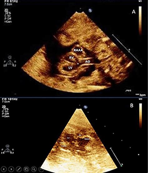 Demonstration Of Fetal Echocardiogram Of The Fetus With A Bilateral Aaa