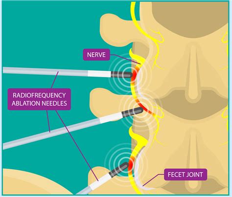 Lumbar Facet Radiofrequency Neurotomy Shore Spine And Pain